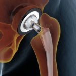 How Reputed Orthopedic Services Help in Hip Recovery