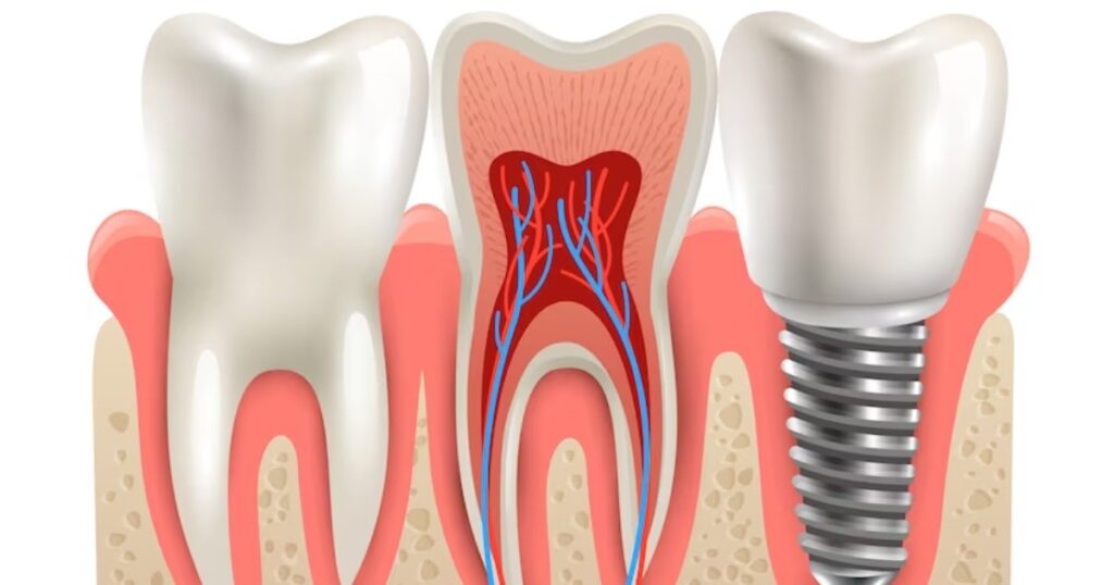 Painless Innovations in Root Canal Therapy: Debunking the Myths