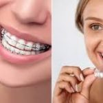 Discover Your Perfect Smile: Braces Solutions at True North Orthodontics