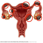 Pain Relief After Endometriosis Surgery: What to Expect